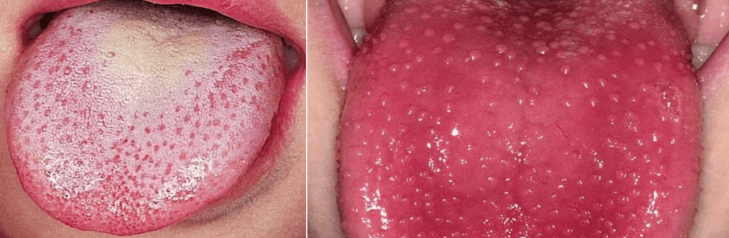 lingua a fragola sintomo tipico della scarlattina