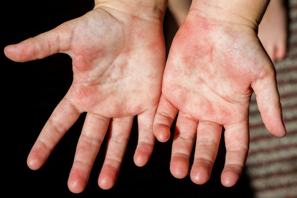 mani con esantema da scarlattina in gravidanza