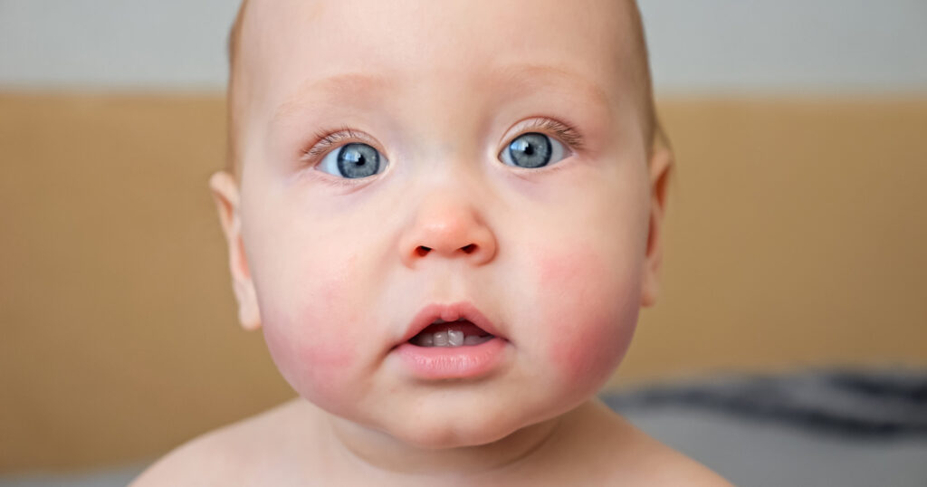 rosacea infantile